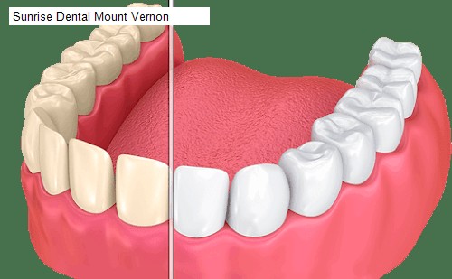 Sunrise Dental Mount Vernon